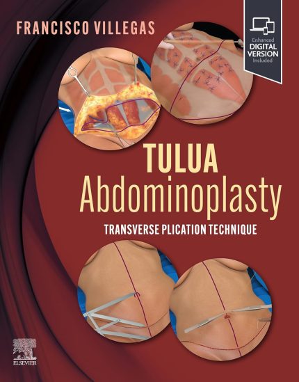 TULUA Abdominoplasty - E-BOOK: Transverse Plication Technique (Digital Download) • I